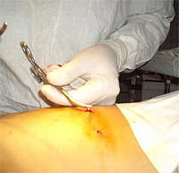 fleboktomia4